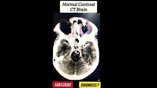 Normal Contrast CT Brain  Radiology [upl. by Ilatfan372]