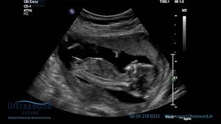 Scan of the Week 15 Weeks Pregnant The Advanced Early Ultrasound [upl. by Aicul601]