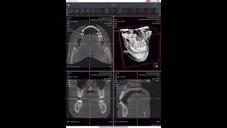 How to upload your CBCT DICOM files and how to use the Medical Viewer in SmileFy [upl. by Maddi]