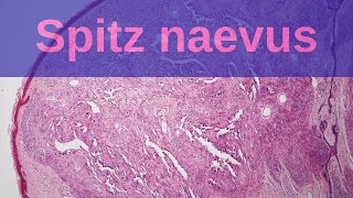 Spitz Naevus  Pathology mini tutorial [upl. by Dnomyaw669]