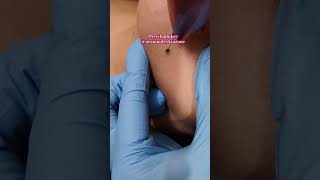 Unwanted mole tags oraismilezone skincare shortfeed drrichadubey viral moletreatment [upl. by Lemaceon]