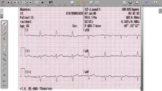 ECG 12 Lead Axis Deviation [upl. by Zamir]