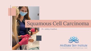 Squamous Cell Carcinoma Surgical Excision [upl. by Iand236]