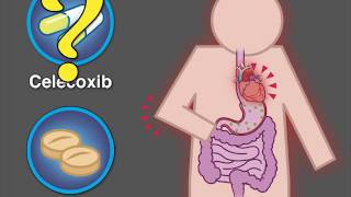 Cardiovascular Safety of Celecoxib  NEJM [upl. by Rhody]