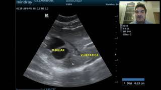 Ecografía abdominal parte 3 [upl. by Ahterahs]