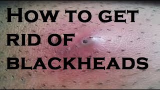 get rid of blackheads [upl. by Dunson988]