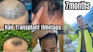 Hair transplant time lapse  Hair transplant before and after results [upl. by Einnob302]