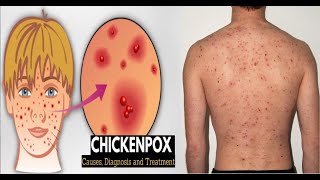 Chickenpox Causes Signs and Symptoms Diagnosis and Treatment [upl. by Halvaard]