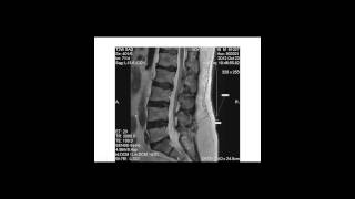 Degenerative disk disease progression over time [upl. by Biegel]