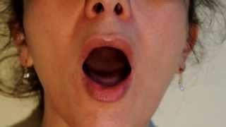 Video 10  Bulbar Palsy  Tongue fasciculations  Atteinte bulbaire  Fasciculations de la langue [upl. by Goode]