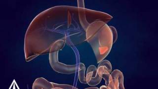 Whipple Procedure  3D Medical Animation [upl. by Hillhouse]