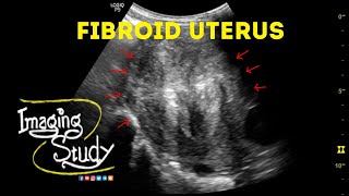 Fibroid Uterus  Ultrasound  Case 45 [upl. by Falo512]