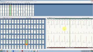 Typcial ECG analysis with ECGpro Holter 743 [upl. by Anoli]