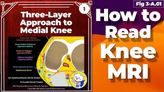 Fig 3A01 ThreeLayer Approach to Medial Knee [upl. by Rodie147]