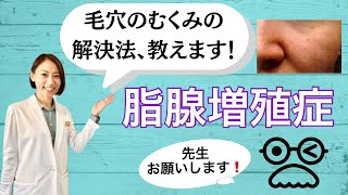 毛穴が浮腫んで詰まる⁈【脂腺増殖症】 [upl. by Sethrida]