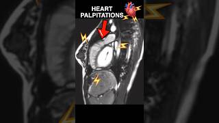 Heart PALPITATIONS under MRI🫀⚡️ anxiety cardiology [upl. by Christiana]