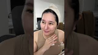 2 Months Post Op Update sa Face Chin Lipo [upl. by Asiar]