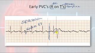 Basic Electrophysiology part 9  Ventricular Rhythms [upl. by Leontyne]