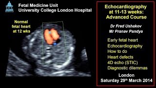 Fetal echocardiography at 1113 weeks ISUOG 2014 advanced course [upl. by Mowbray]