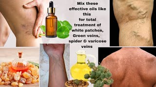 MIX THESE OILS TO CLEAR WHITE PATCHES amp GREEN VIENS  SKIN REPAIR OIL  RESULT IN 7 14 DAYS [upl. by Valley]