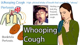 Whooping cough  Pertussis Hacking cough Symptoms and treatment [upl. by Xineohp447]