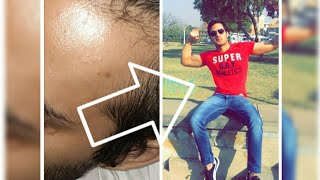 FINAX finasteride 304 दिनDays of usageBefore AfterReview Watch till the end Hindi [upl. by Adyht]