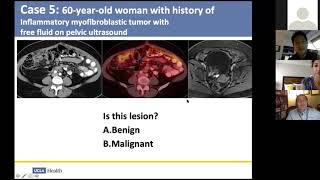 Inflammatory myofibroblastic tumor with omental disease Victor Sai [upl. by Nomor]