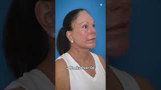 Stunning 6Month Preservation Facelift Transformation [upl. by Seilenna]