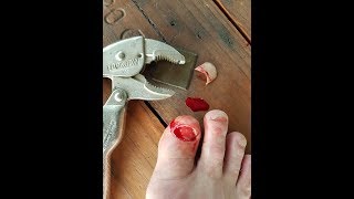 Big Toenail Removal with Vice Grips [upl. by Stanleigh]