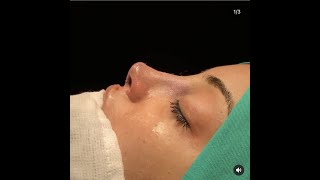 A Natural Result with Open Revision Rhinoplasty  Reconstruction with rib cartilage [upl. by Atniuq578]