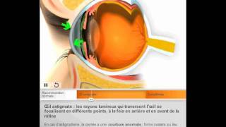 Lastigmatisme par Quantel Medical [upl. by Eerbua]