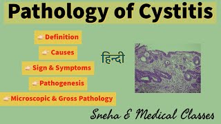 Pathology of Cystitis  Causes Sign amp symptoms pathogenesis Gross amp microscopic pathology [upl. by Lavery]