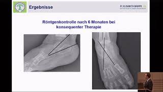 0715  Die Klumpfußdeformität Teil 2 [upl. by Aubreir]