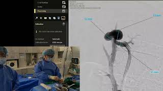 Pulmonary arteriovenous malformation embolization with plugs and coils 폐동정맥기형색전술 [upl. by Ardys884]