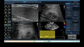 IQ 287 KIDNEY FIBROSIS ECHOPAC ANALYSIS ULTRASOUND 5 [upl. by Anatola808]