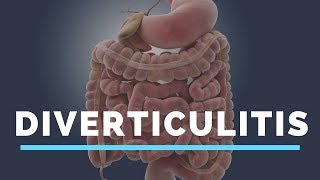 Diverticulitis True Facts About Diverticular Disease or Diverticulosis [upl. by Ripleigh]