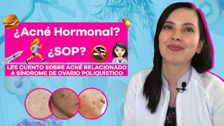 ¿Acné hormonal Síndrome de ovario poliquístico y piel [upl. by Tham]