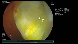 ruptured hydatid cyst in the common bile duct [upl. by Kerns]