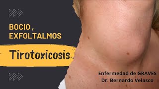 ABULTAMIENTO EN CUELLO TAQUICARDIA NERVIOSISMO Tirotoxicosis Enfermedad de GRAVES Ojos saltones [upl. by Akilak]