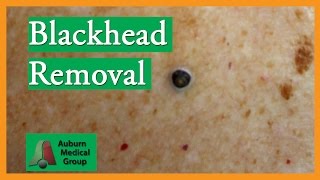 Blackhead Removal without Extractor Tool Edited  Auburn Medical Group [upl. by Ridley]