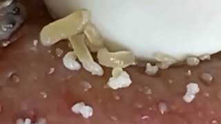 Blackheads amp Whiteheads Satisfying Removal 0319 [upl. by Angel381]