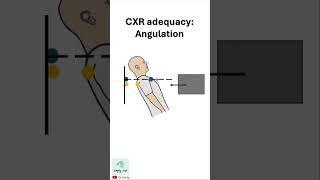 Chest xray adequacy ANGULATION [upl. by Anaer]