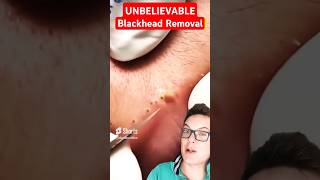 Stunning LIP BLACKHEAD REMOVAL  Biggest Blackheads Ever shorts [upl. by Maleen]