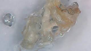 Aspergillus Fumigatus amp Morgellons Disease The Silent Pandemic  Undecylenic Acid out of stock [upl. by Cooperstein166]