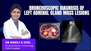 EUS B IN ADRENAL MASS DR MANOJ GOELbronchoscopy lungcancer fmri ebus fortis pulmonologist [upl. by Rein498]