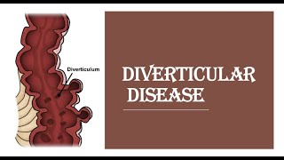 Diverticular diseasediverticulitis  pathogenesis clinical feature investigation management [upl. by Llenaj341]