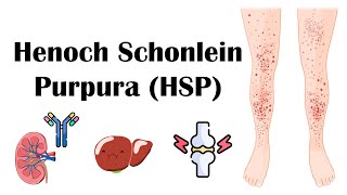 Henoch Schoenlein Purpura HSP  Causes Pathophysiology Diagnosis And Treatment [upl. by Farver]