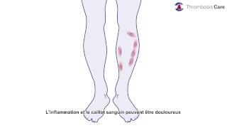 la thrombose veineuse superficielle [upl. by Ramberg]