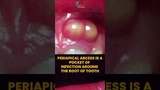 Periapical Abscess  Symptoms Treatment Options amp When to See a Dentist  Apollo Dental [upl. by Leahcimed664]