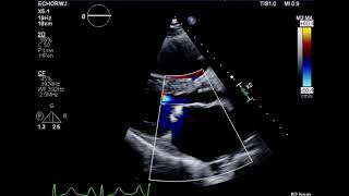 Mitral Stenosis Rheumatic Heart Disease ParaSternal Long mitral valve Color Flow Doppler [upl. by Ashton]